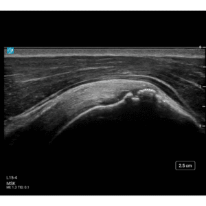kliniske MSK billeder af høj kvalitet med Sonosite ST ultralydsscanner 