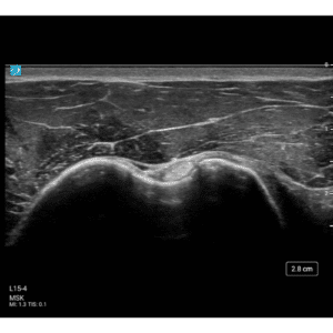 kliniske MSK billeder af høj kvalitet med Sonosite ST ultralydsscanner 