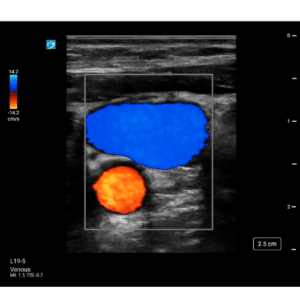 kliniske billeder af høj kvalitet med Sonosite ST ultralydsscanner 