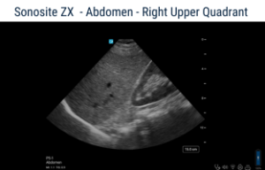 ultralydsscanner til scanning af abdomen