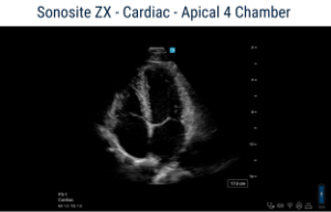 Ultralydsscanner til scanning af hjertet cardiac scanninger