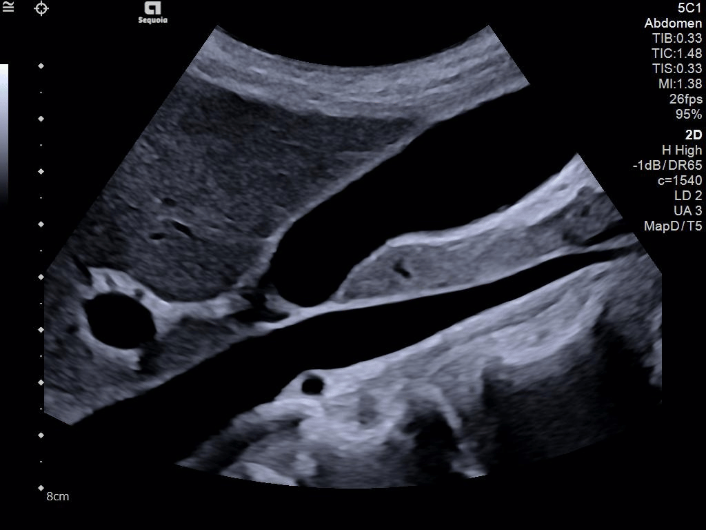 Siemens Sequoia - Clinical Image - Abdominal 8