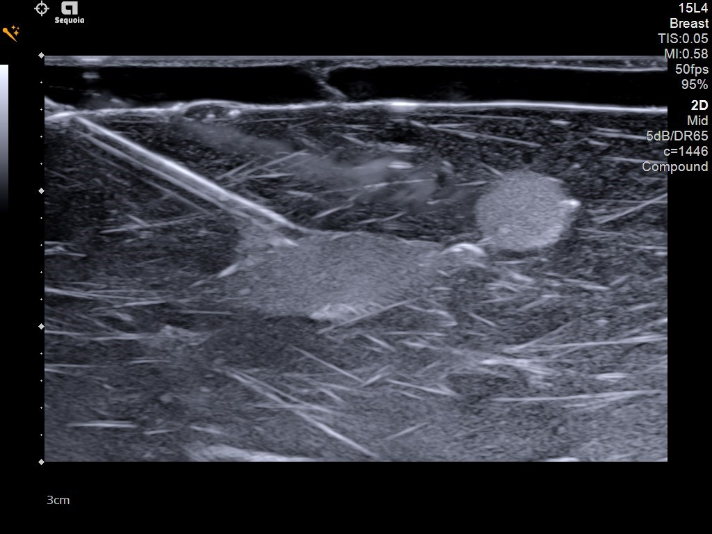 Siemens Sequoia - Clinical Image - Breast 2