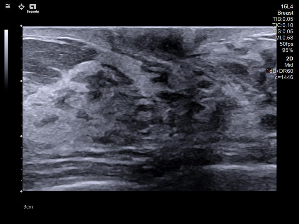 Siemens Sequoia - Clinical Image - Breast 4