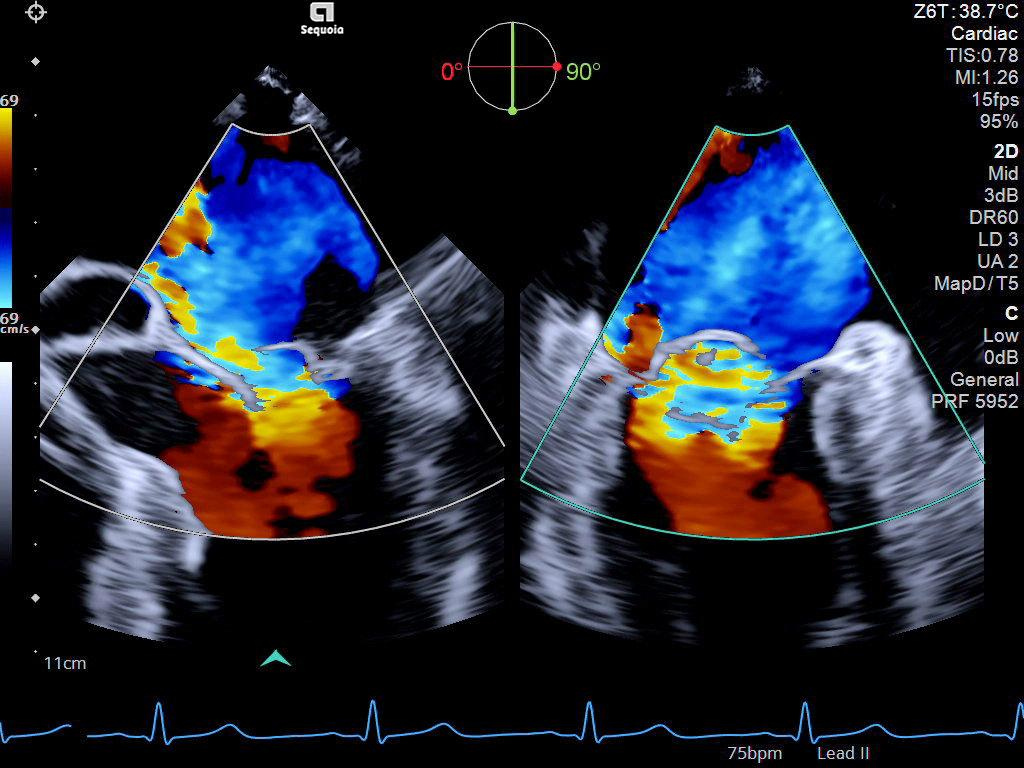 Siemens Sequoia - Clinical Image - Cardiac 6