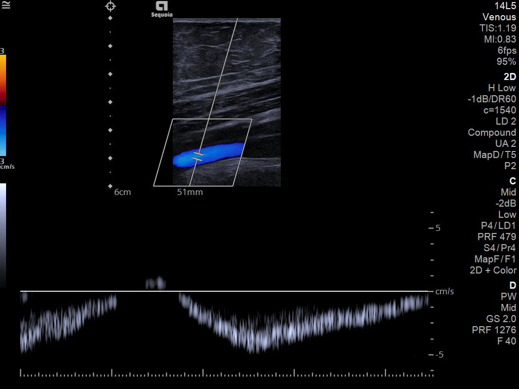 Siemens Sequoia - Clinical Image - Cardiac 8