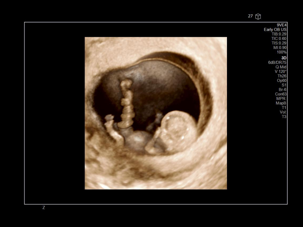 Siemens Sequoia - Clinical Image - OB-GYN 1