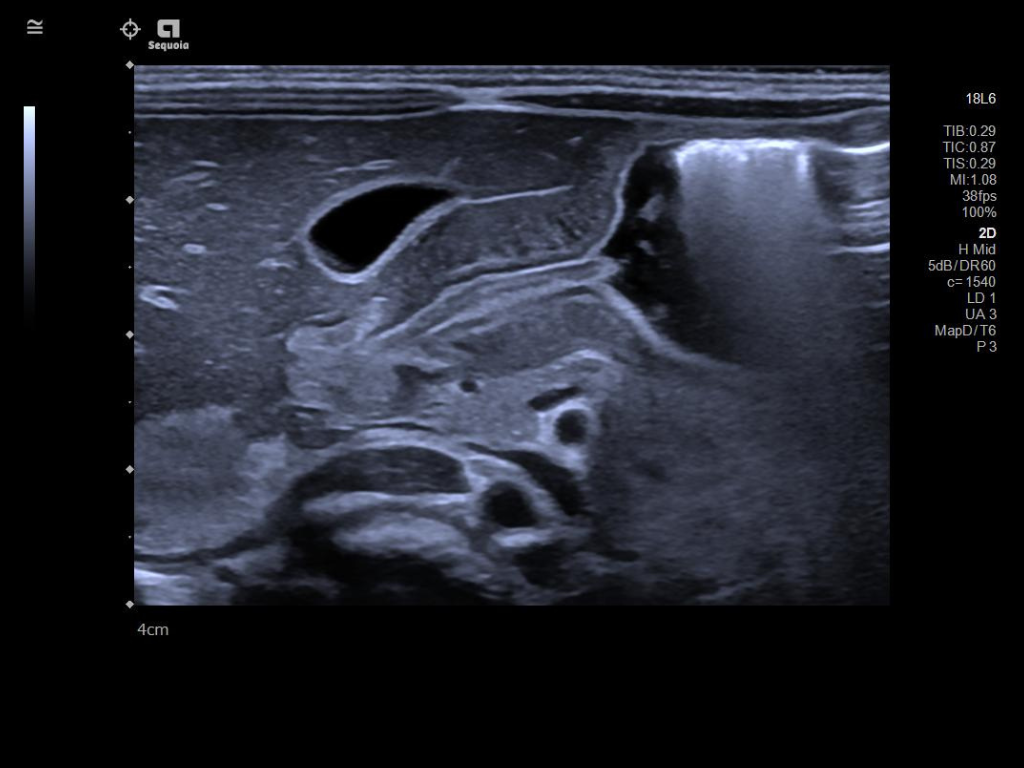 Siemens Sequoia - Clinical Image - Pediatric 1
